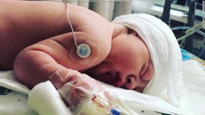 Baby born without skull in the back of his head defies odds